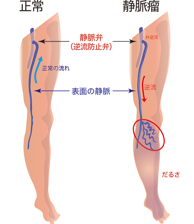 静脈の怒張（はれ）