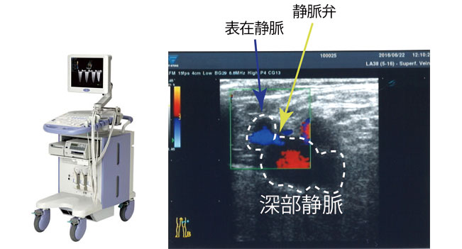 超音波検査