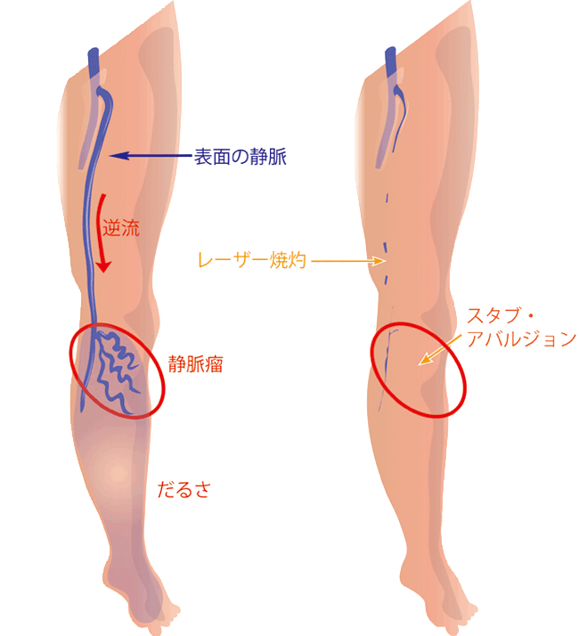 スタブアバルジョン